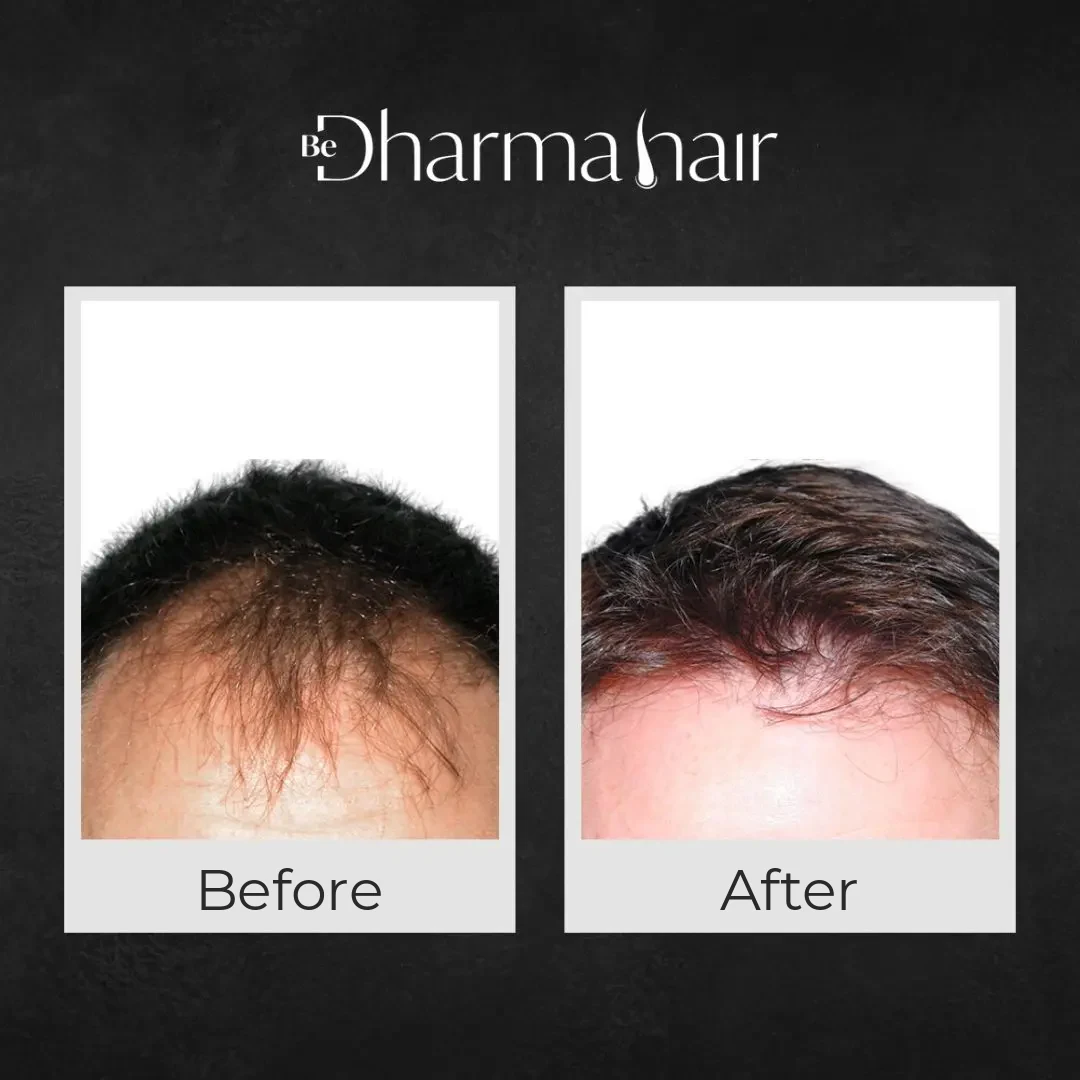 Hair transplant before and after at Dharma Hair in Medellín: hairline (FUE)