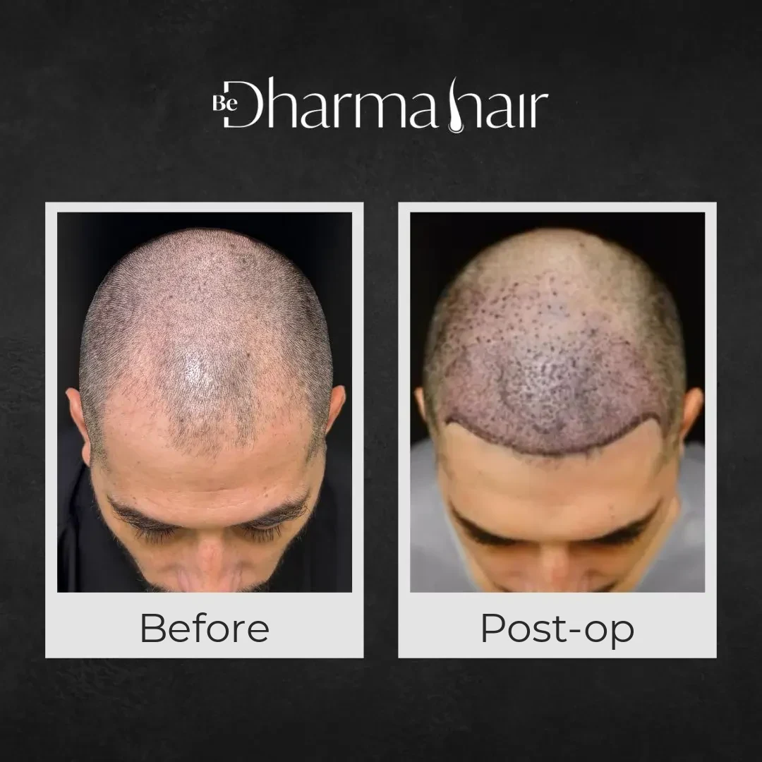 Scalp right after a hair transplant, showing the planned hairline design