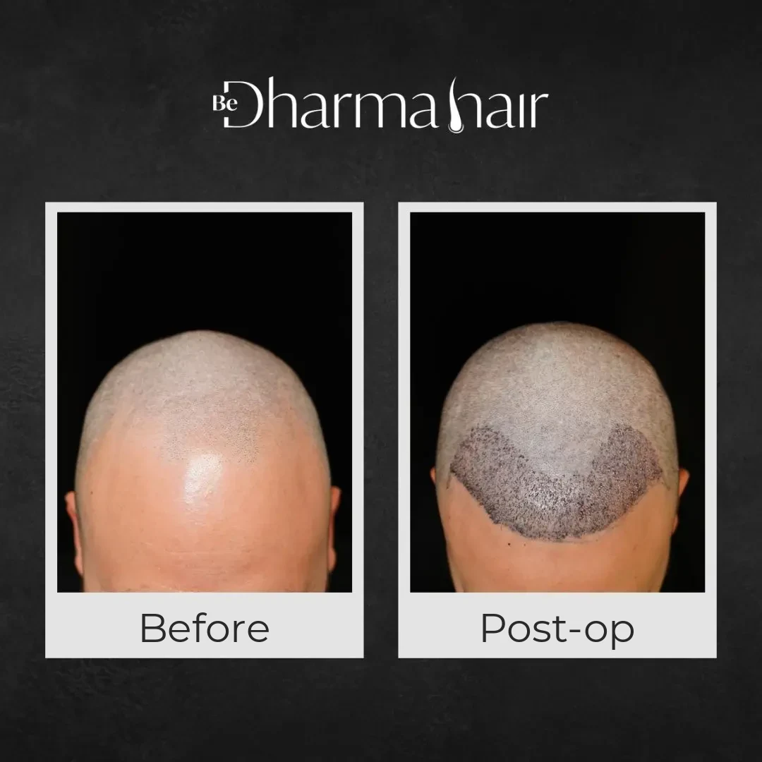Top of the scalp before and right after hair transplant surgery
