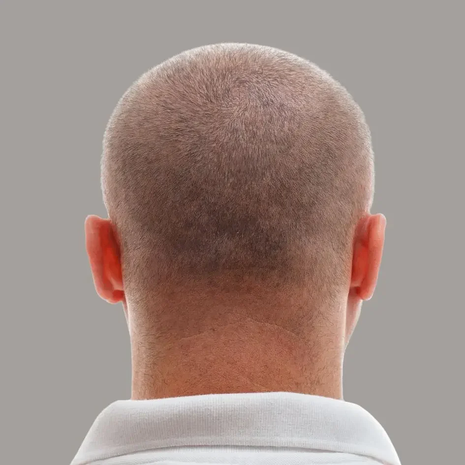 Illustration of the same crown with restored hair coverage