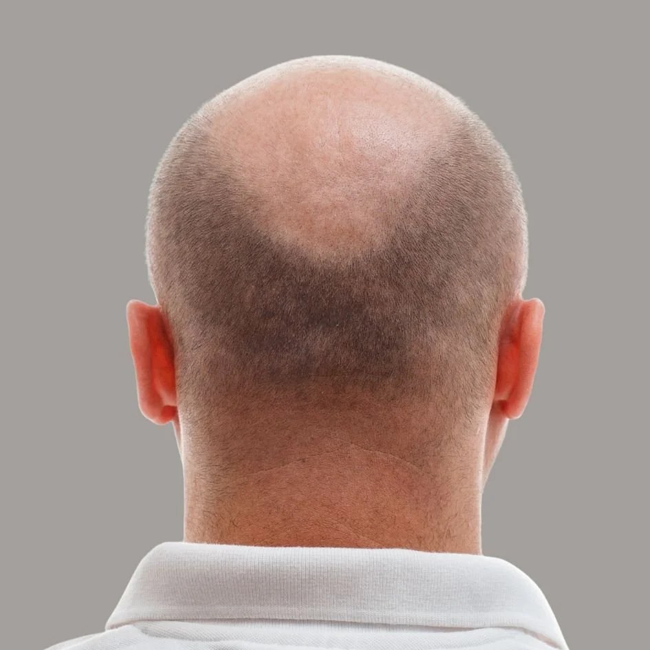Illustration of a thinning crown before a hair transplant