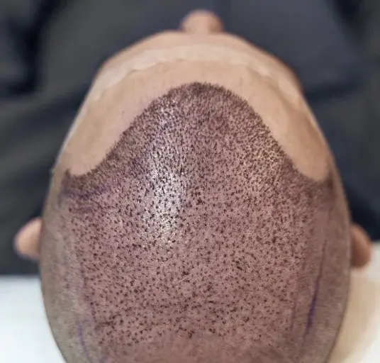 Recipient area of a hair transplant patient on the day of surgery, with the grafts in place, Dharma Hair Medellín