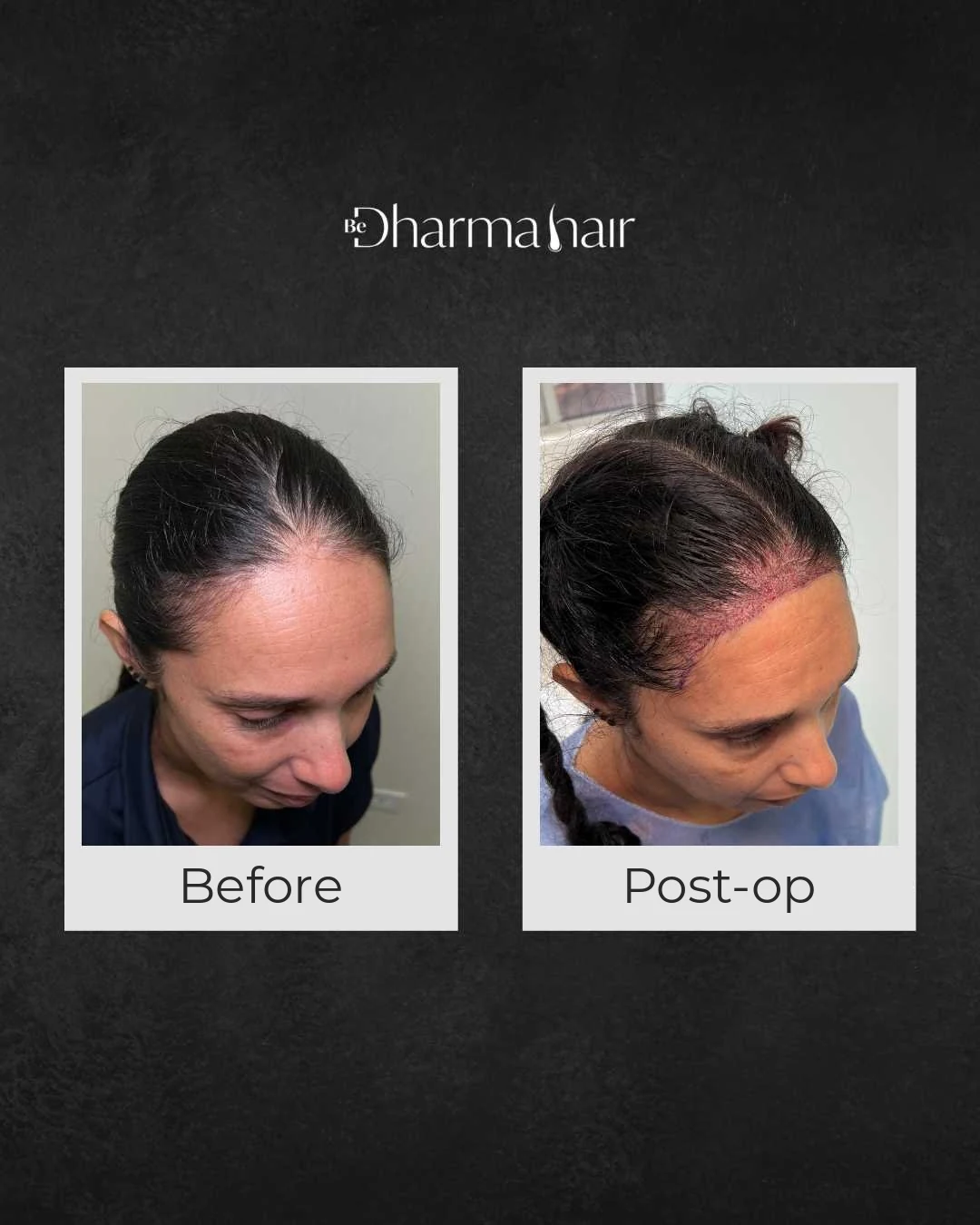 Women's hair transplant: hairline before surgery and on the day of surgery