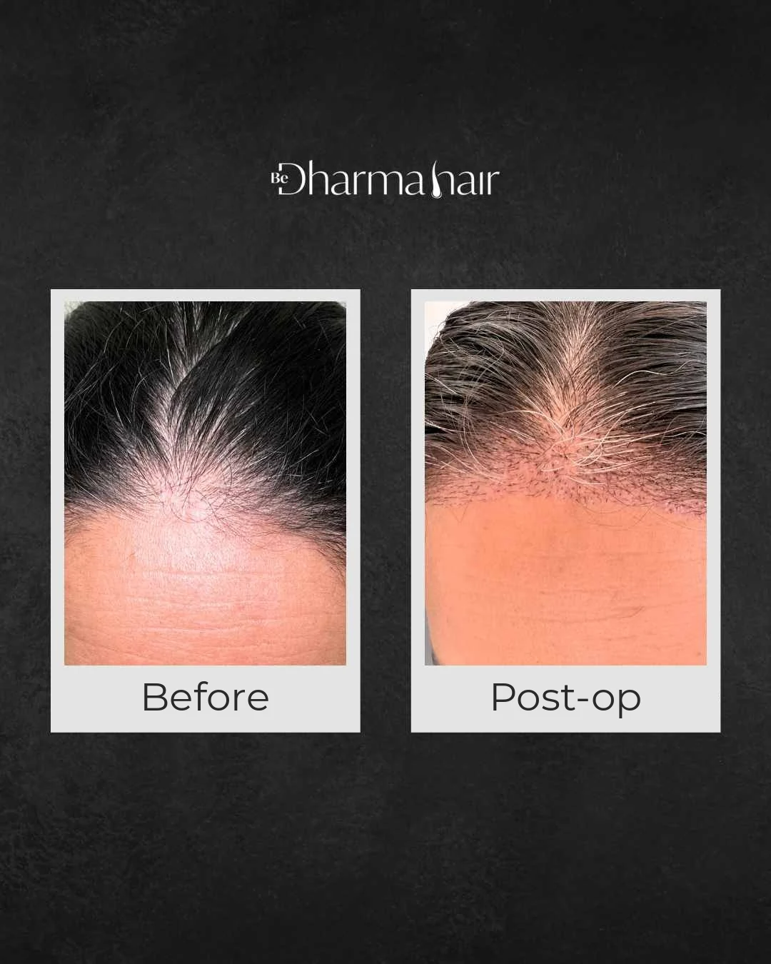 Women's hair transplant: front hairline close-up before surgery and on the day of surgery