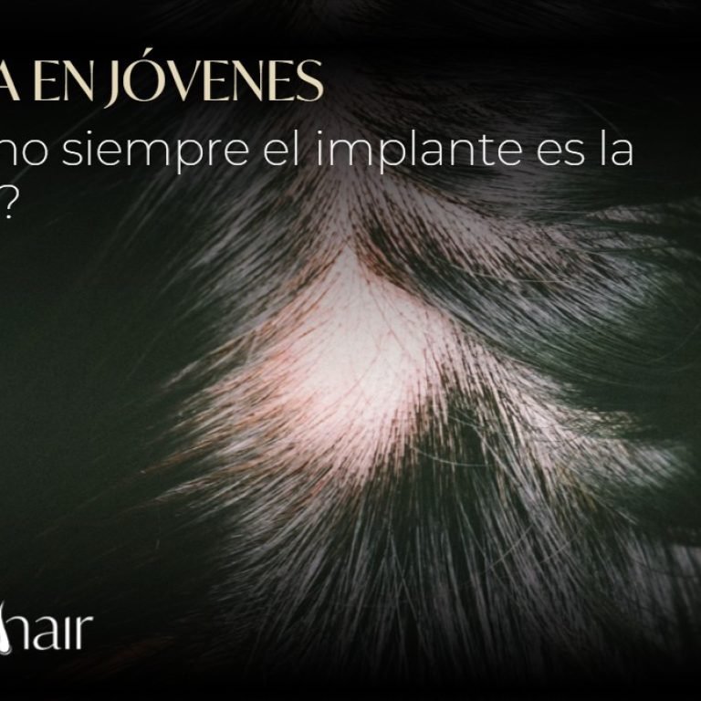 Alopecia en jóvenes-Dharma Hair