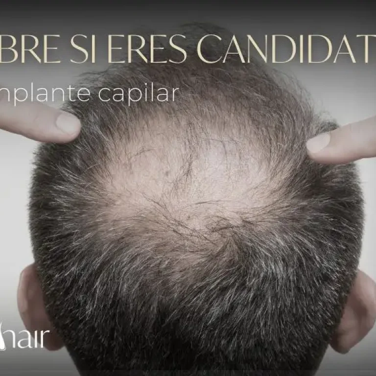 Candidatos para implante capilar en Medellín Colombia - Dharma hair