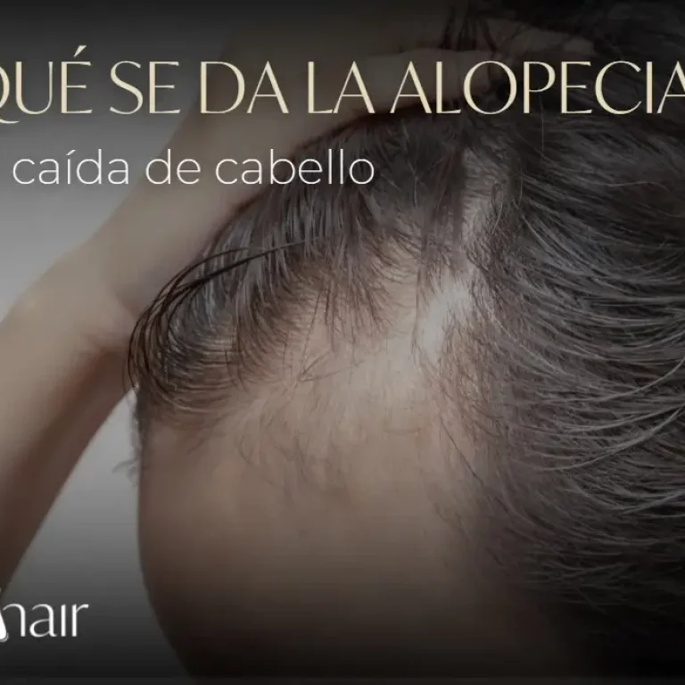 ¿Por qué se da la alopecia?-Dharma Hair