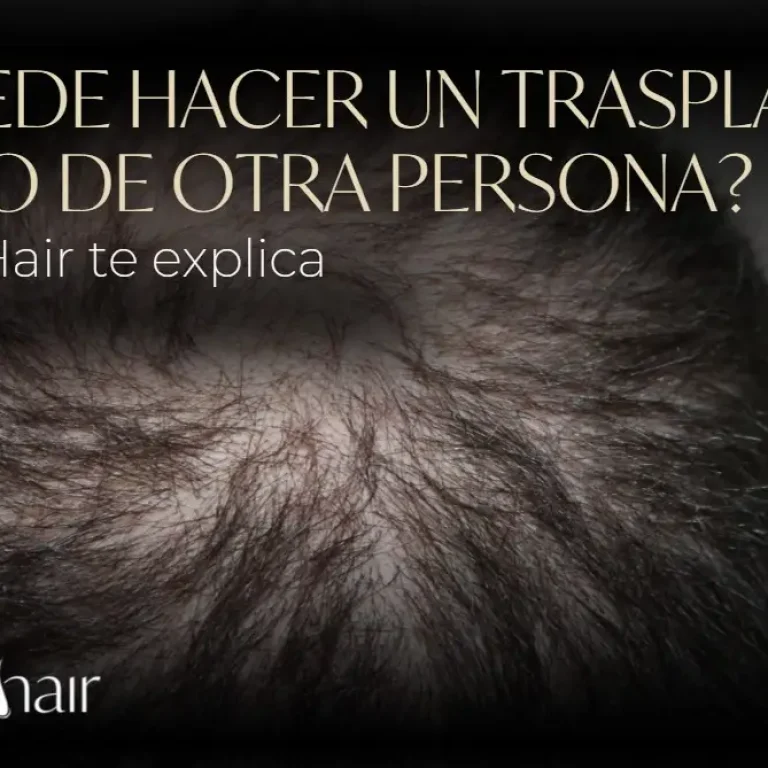 ¿Se puede hacer un trasplante de pelo de otra persona?-Dharma Hair