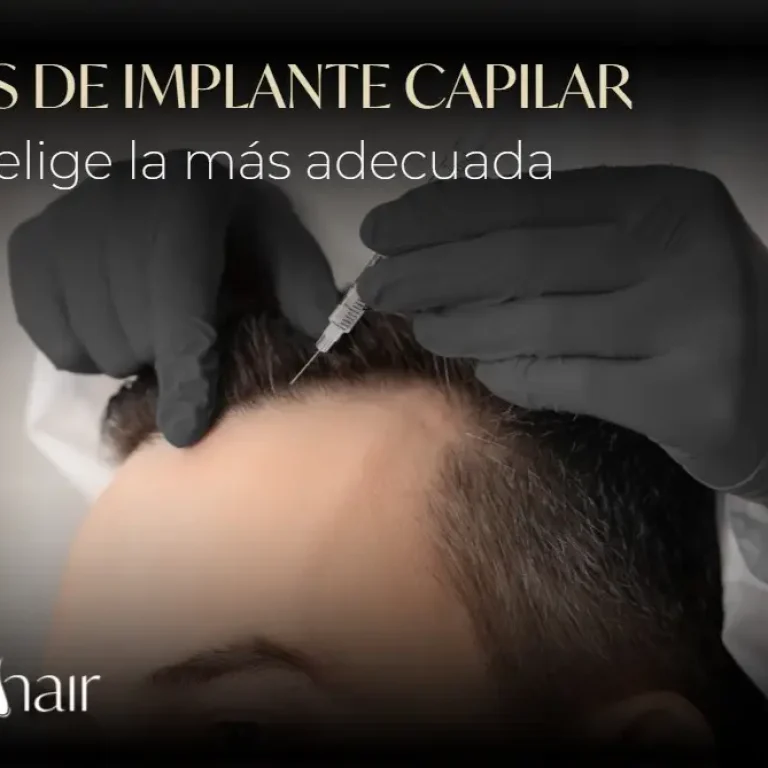 Técnicas de implante capilar- Dharma Hair