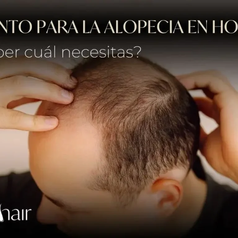 Tratamiento para la alopecia en hombres cómo saber cuál necesitas - Be Dharma Hair